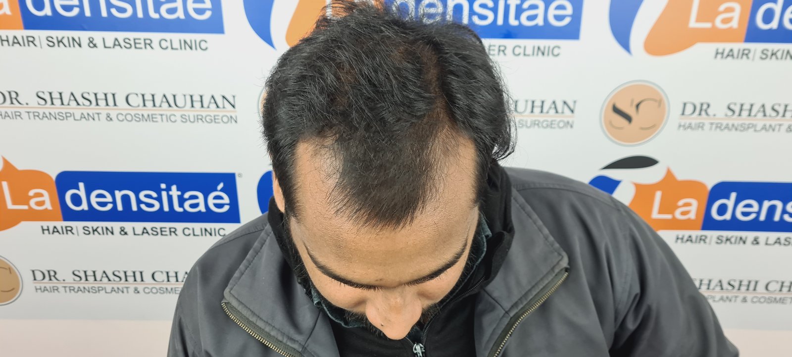 Shreyankar Maurya Before Hair Transplant